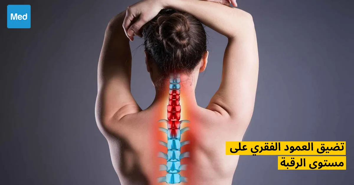 تضيق العمود الفقري على مستوى الرقبة